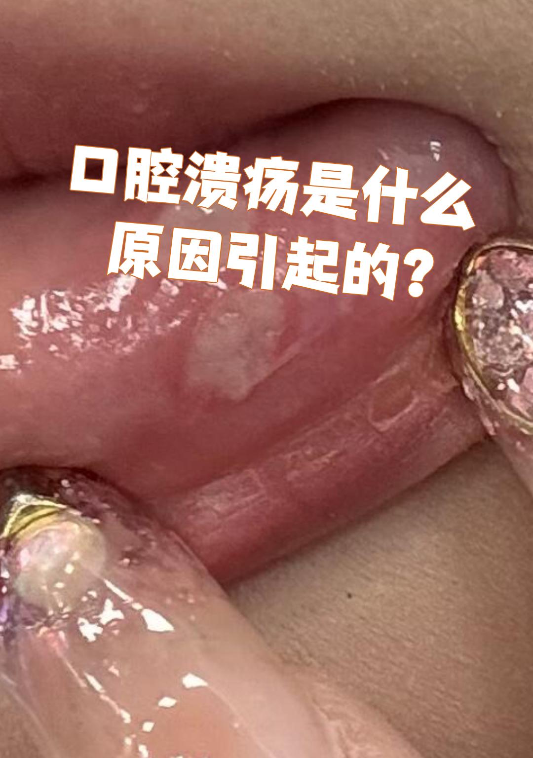 口腔溃疡是什么原因引起的?