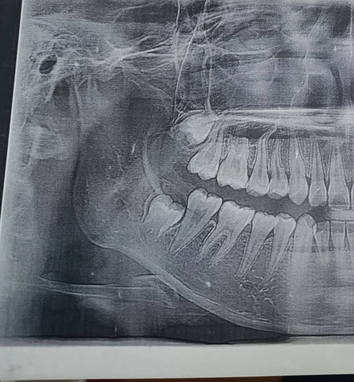 我的智齿长着长着就歪了 p1是六年前的了那时候智齿都还没有长出来 p2