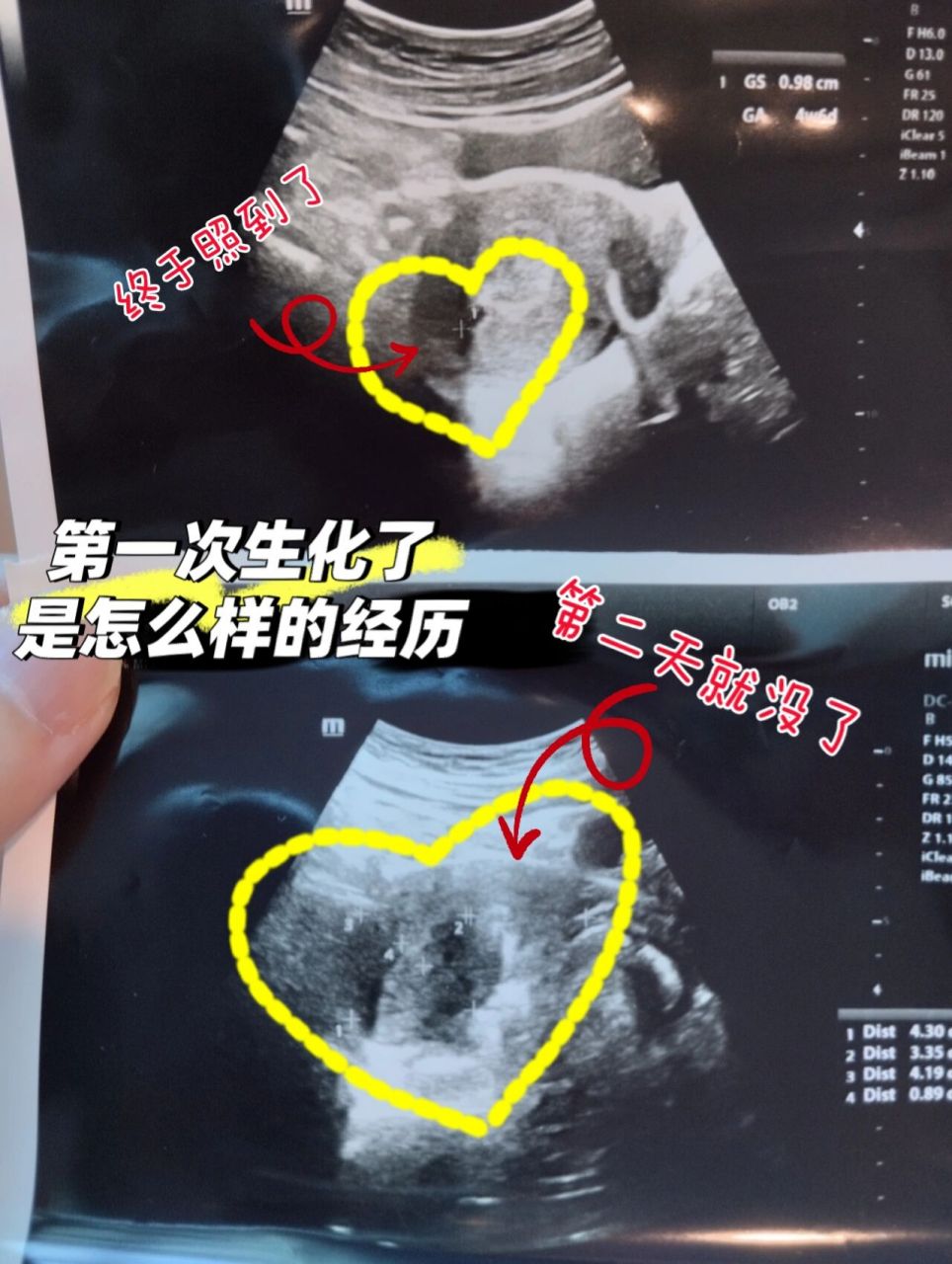 目前还在备孕或孕前期焦虑自己是不是生化了的妈咪,希望以下的分享