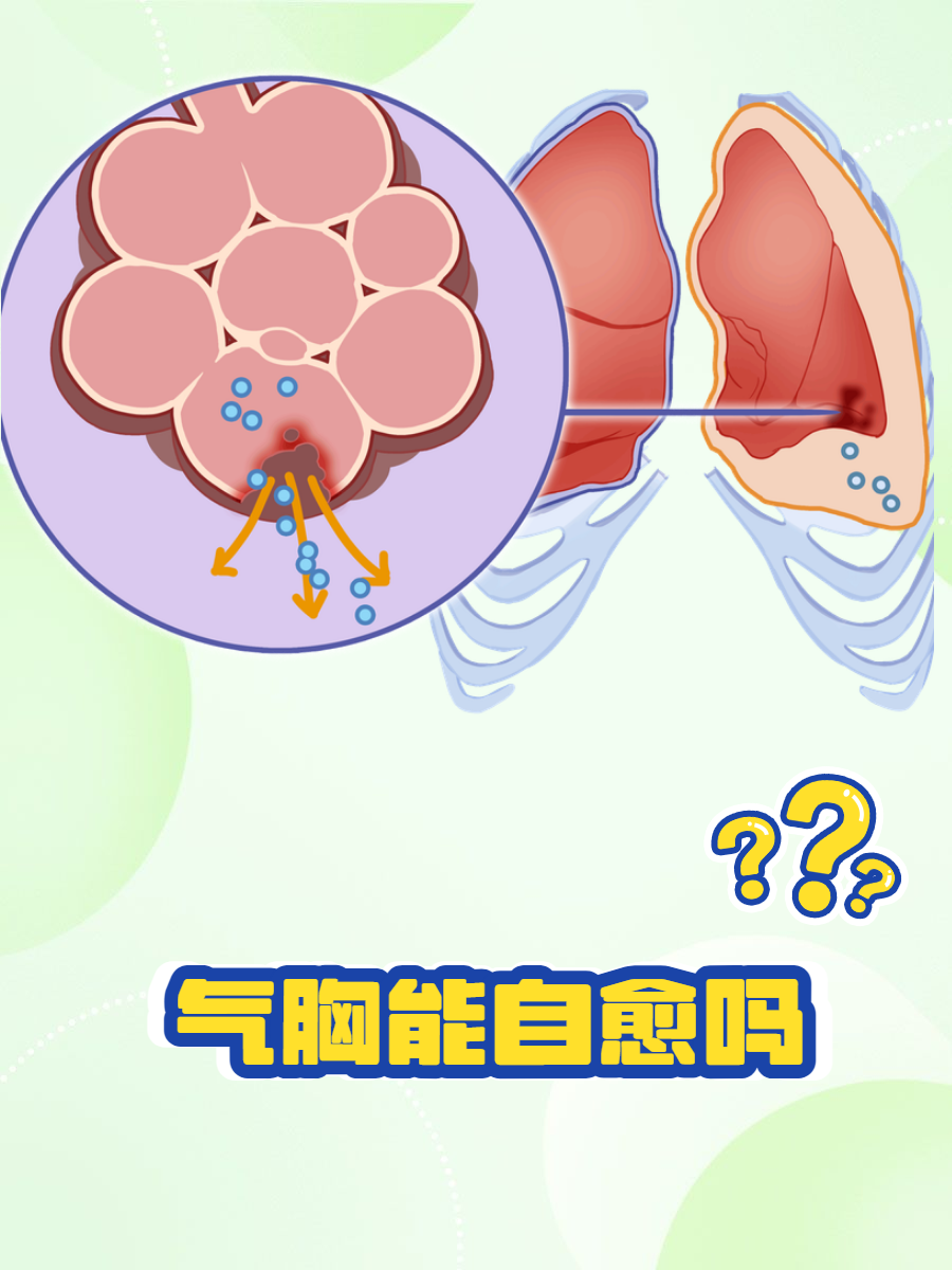 熬夜气胸图片