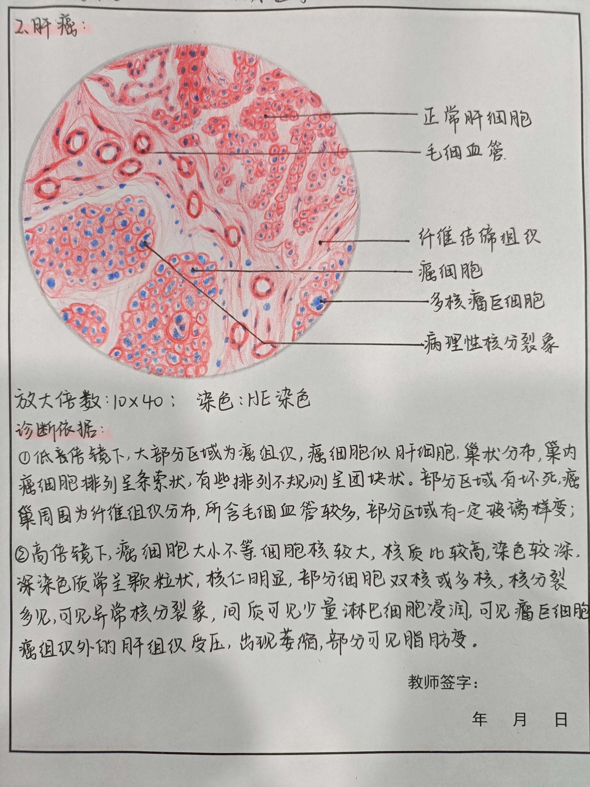 胃溃疡镜下手绘图图片