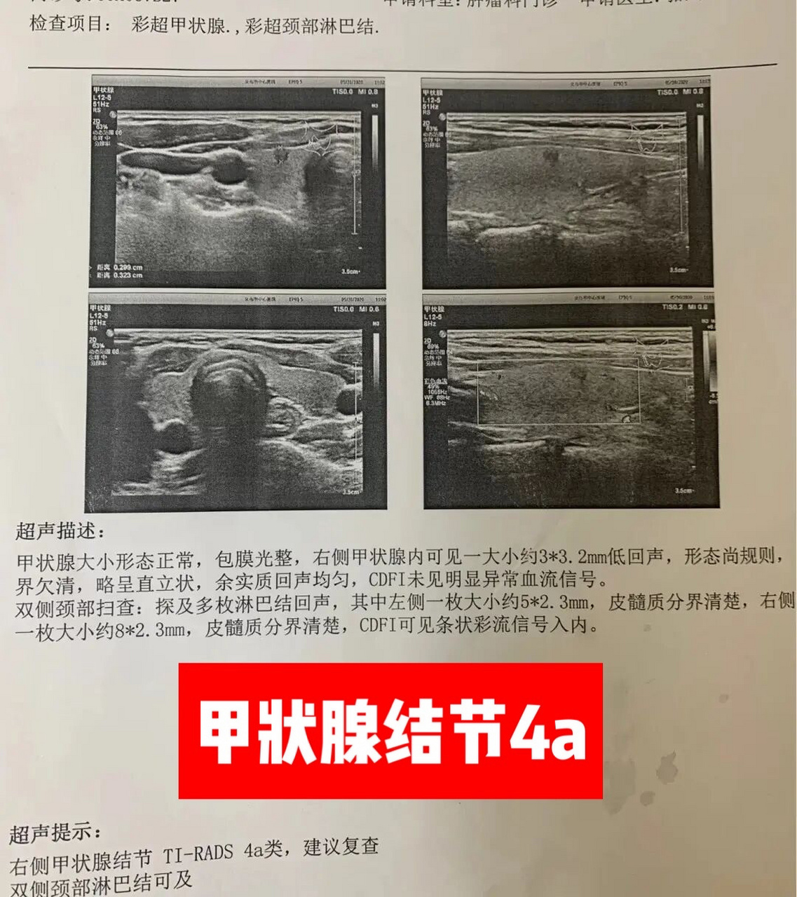 甲状腺结节4a到底严不严重?