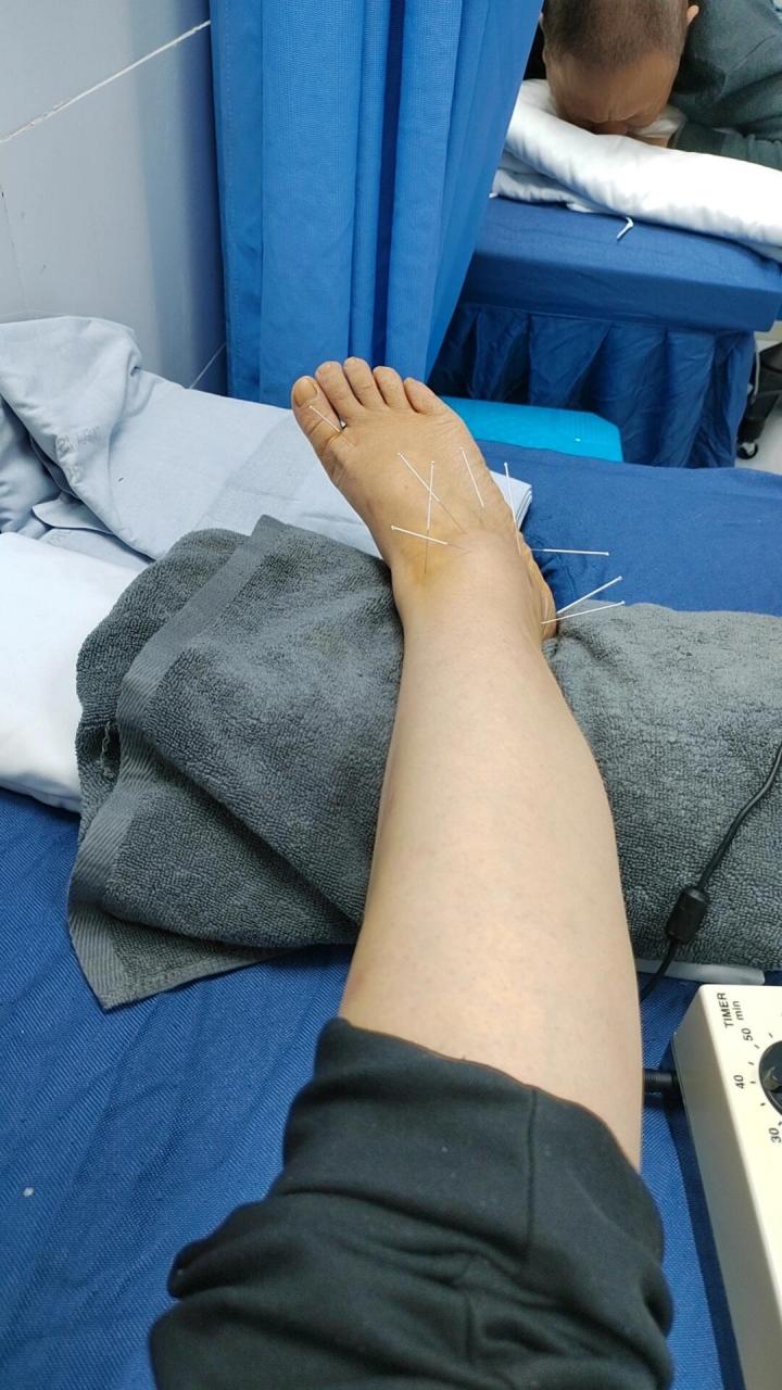 脚踝扭伤肿了,走路不痛了一直不消肿 脚踝伤了,二十几天了还不消肿