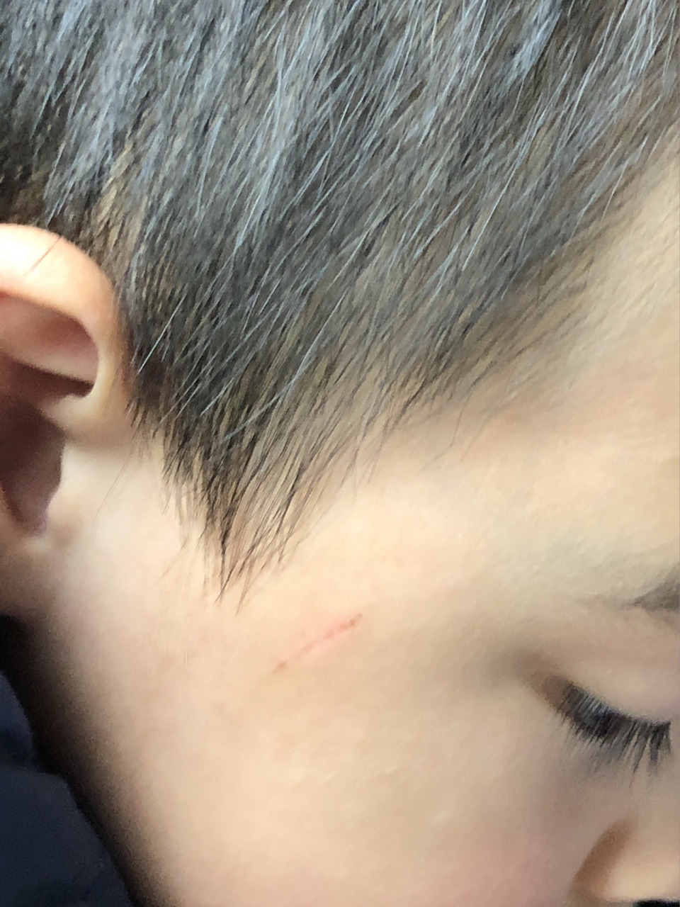 指甲抓破了脸 被邻居小孩指甲抓破了,今天一周了,结痂脱落后凹陷了