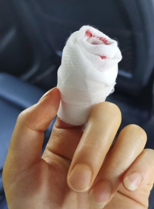 手割破了要止血,可以试试加压包扎,用药,压住手指动脉或者做手术