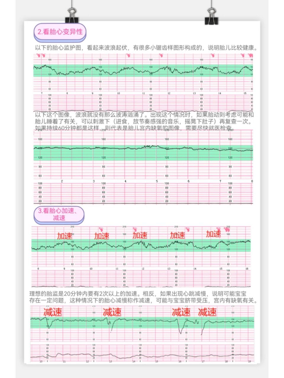 规律宫缩胎监图图片