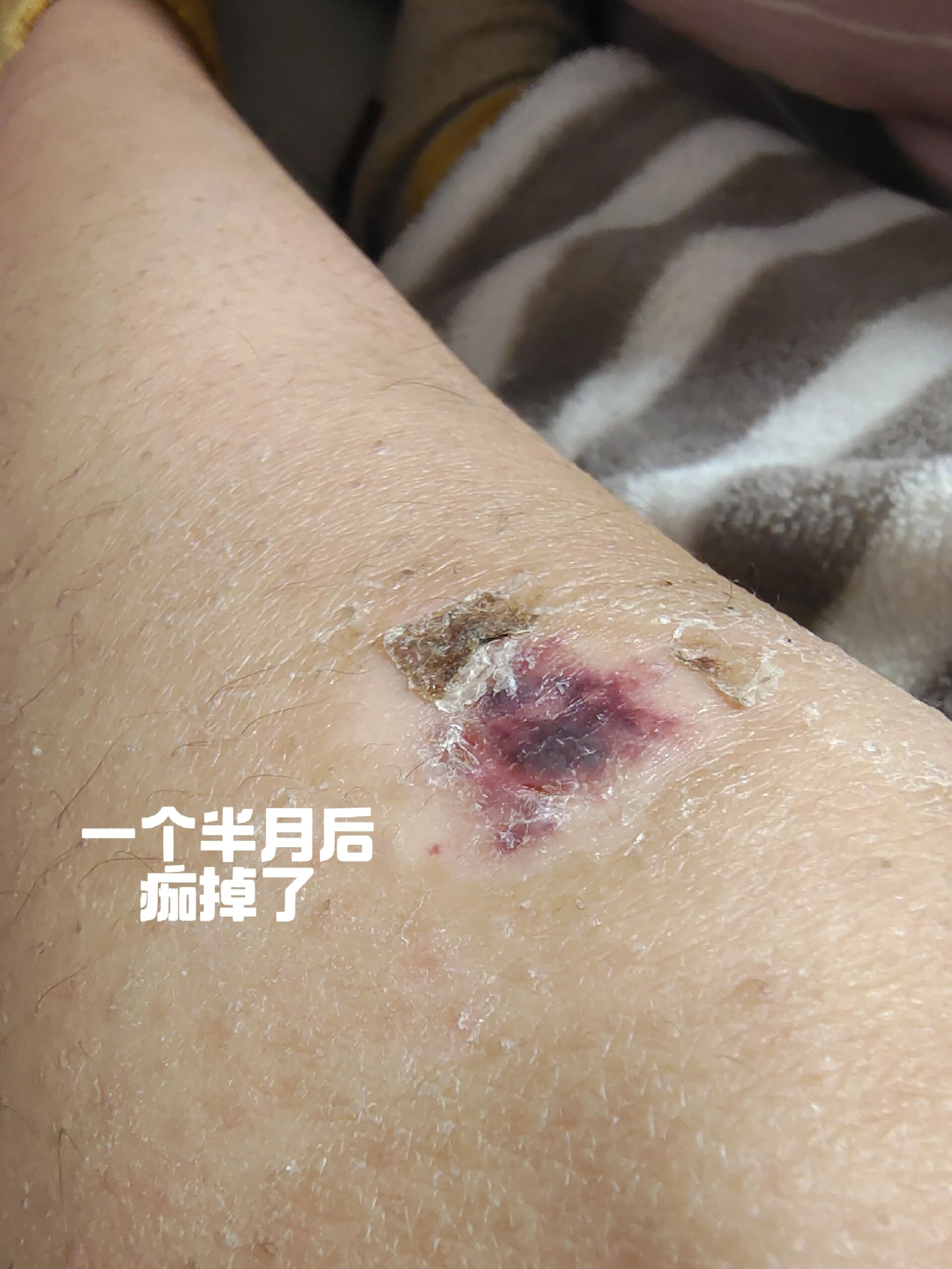 骑车摔了膝盖不知道会不会留疤 一开始以为不严重