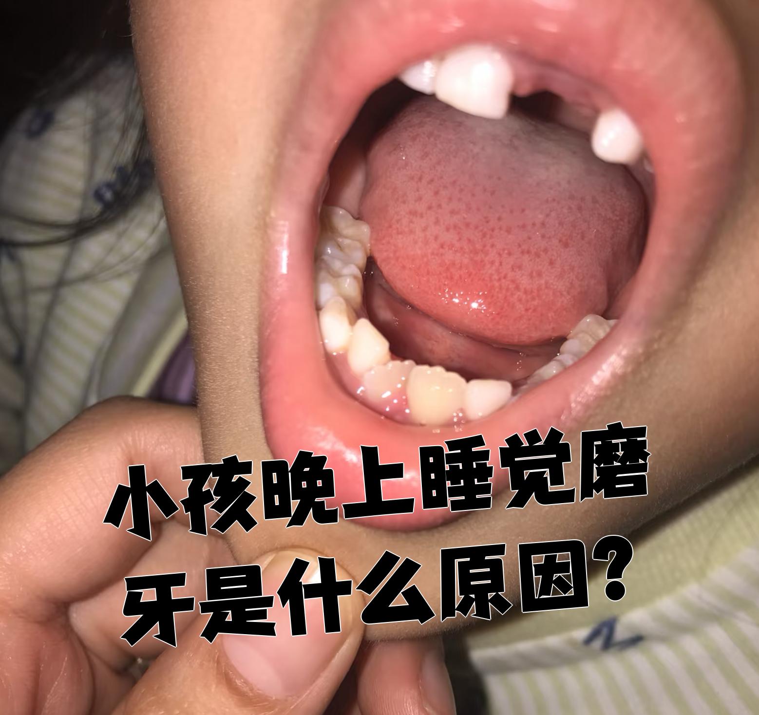 孩子晚上睡觉磨牙主要有三个常见原因:寄生虫感染,缺钙和口腔问题