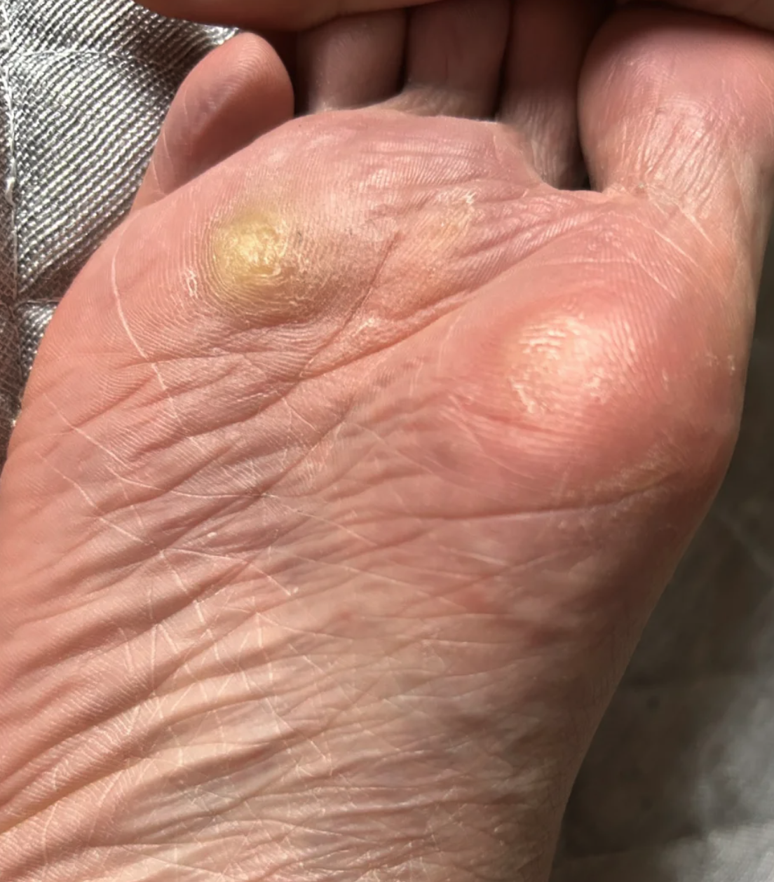 脚上老茧(医学上叫胼胝)反复长,主要和摩擦有关