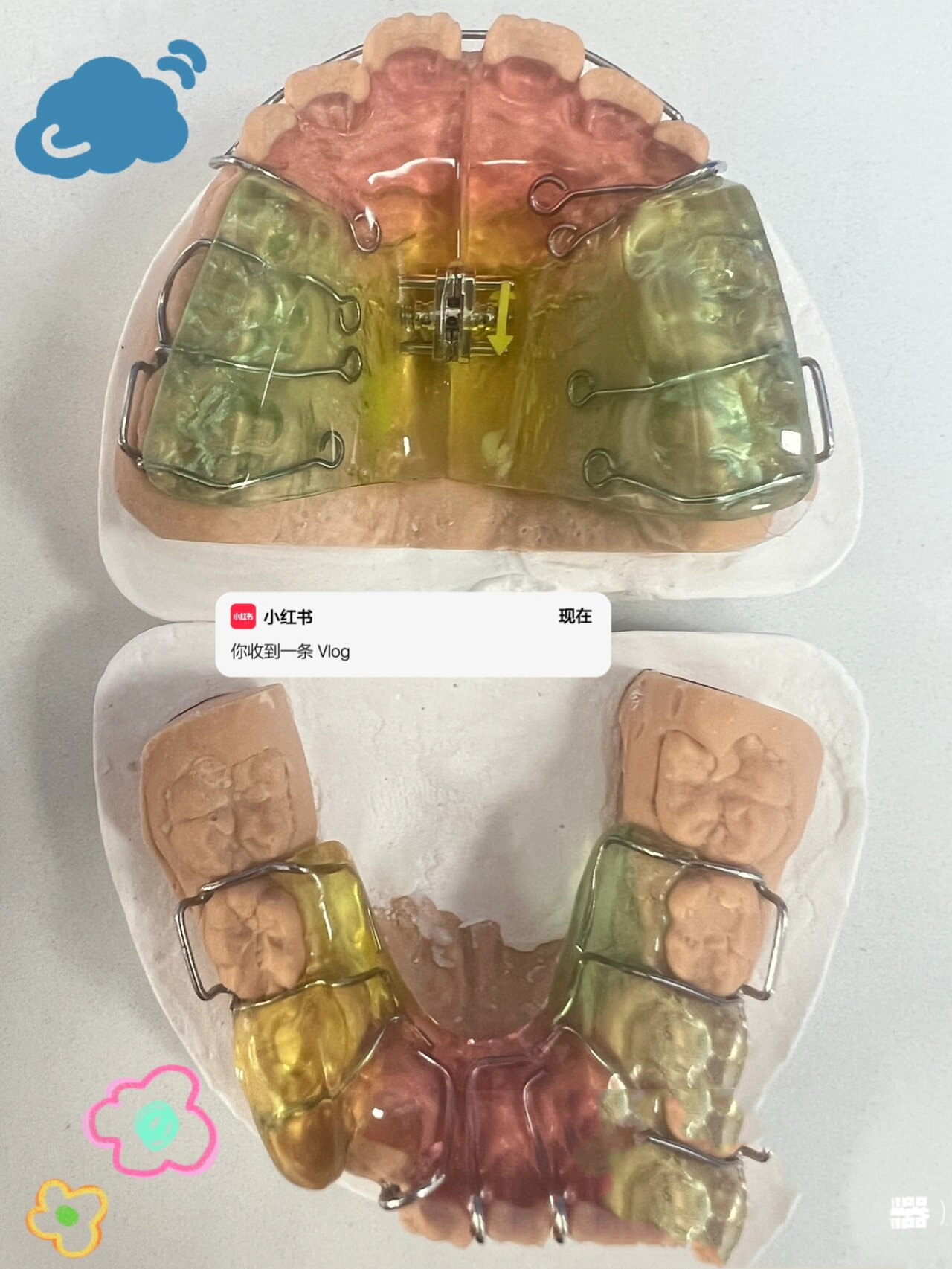 下颌后缩矫正—双颌矫治器(twin-block)7515 twin-block的临床