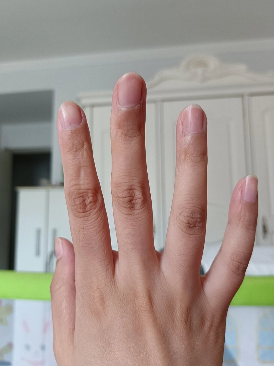 类风湿性关节炎 确诊类风湿性关节炎半年了,只有右手中指关节在弯曲时