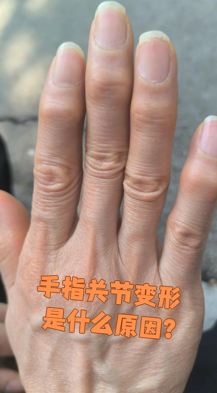 手指关节变形常见的原因包括外伤,类风湿性关节炎,痛风性关节炎秃 