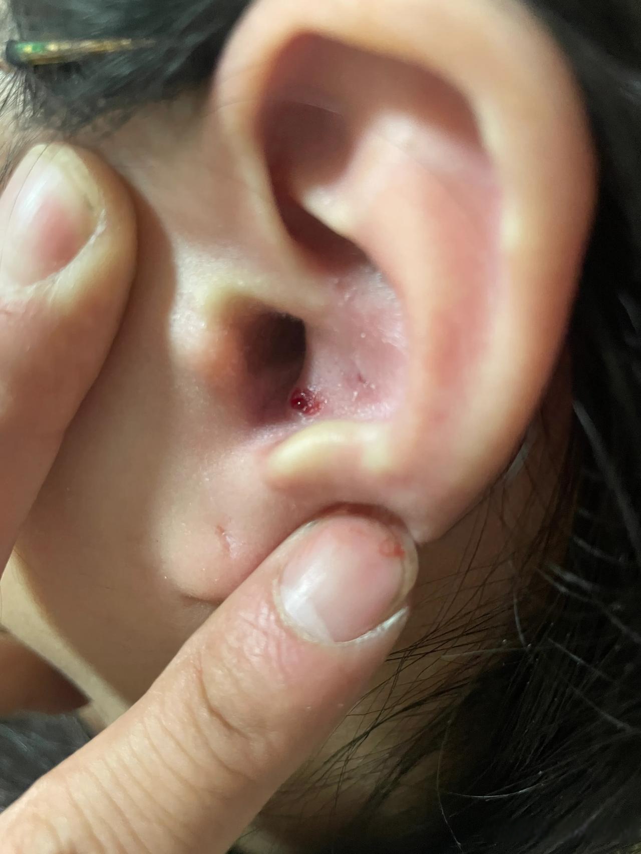 耳朵怎么?大家聊聊耳后脓包