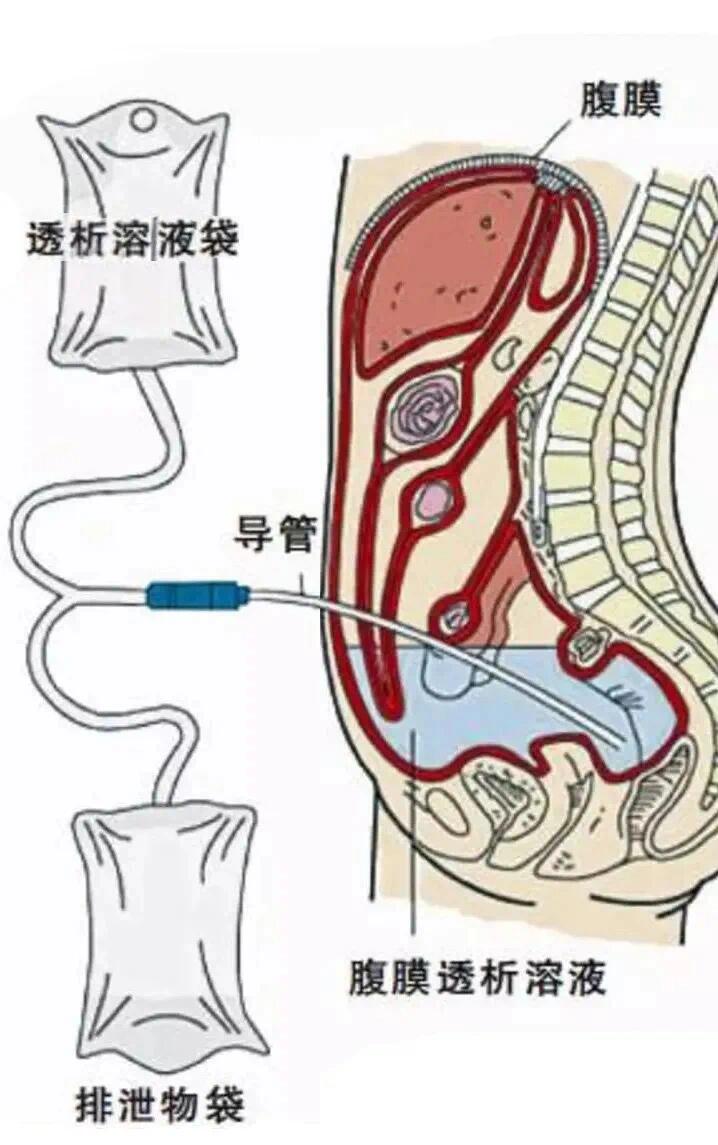 腹透和血透哪种更好图片