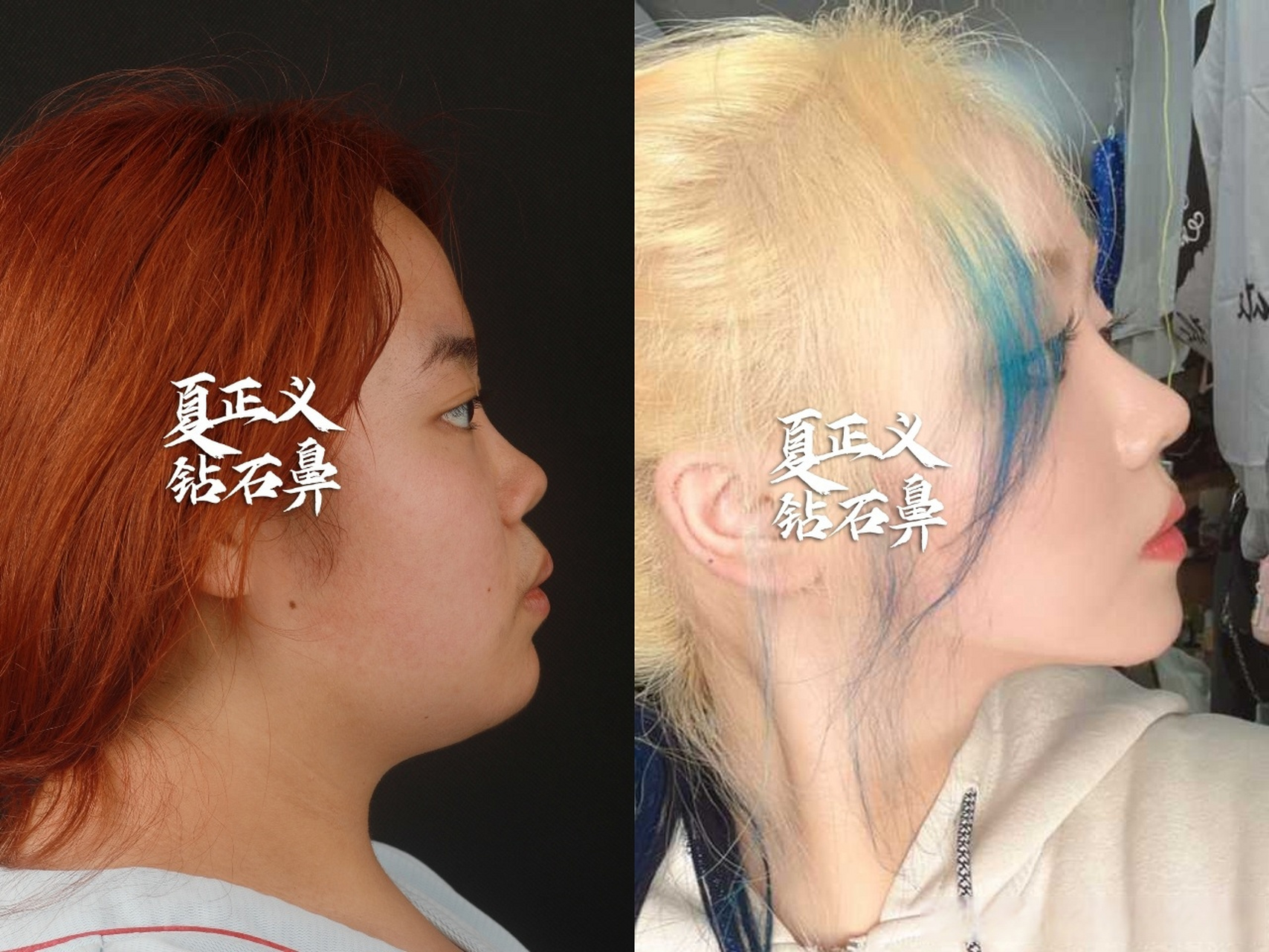 来自粉丝的反馈,短鼻延长,术后4个月.