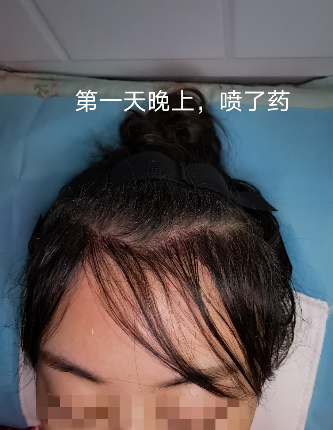 植发雍禾比碧莲盛贵吗(碧莲盛和雍和哪家植发好)