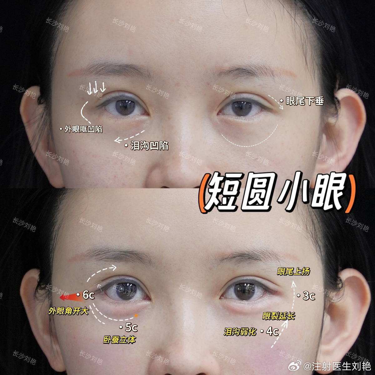 小姐姐是标准的短圆眼,眼裂窄,眼睛短小且圆,伴随着眼尾下垂,双眼皮