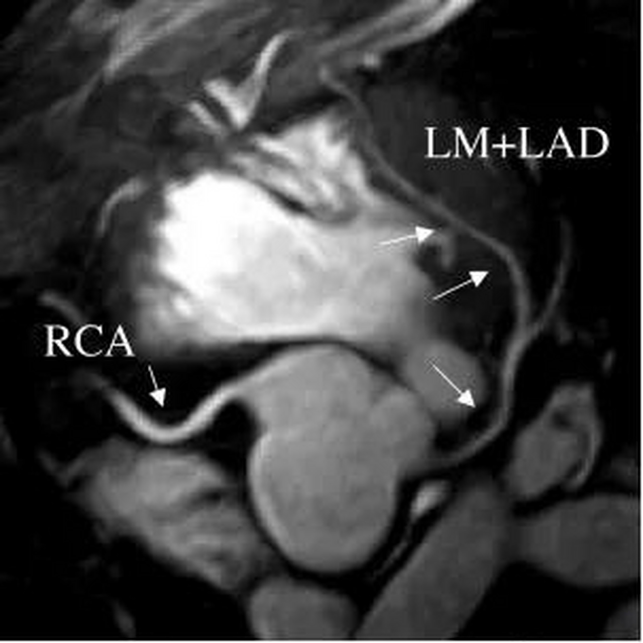 心脏冠状动脉磁共振图像