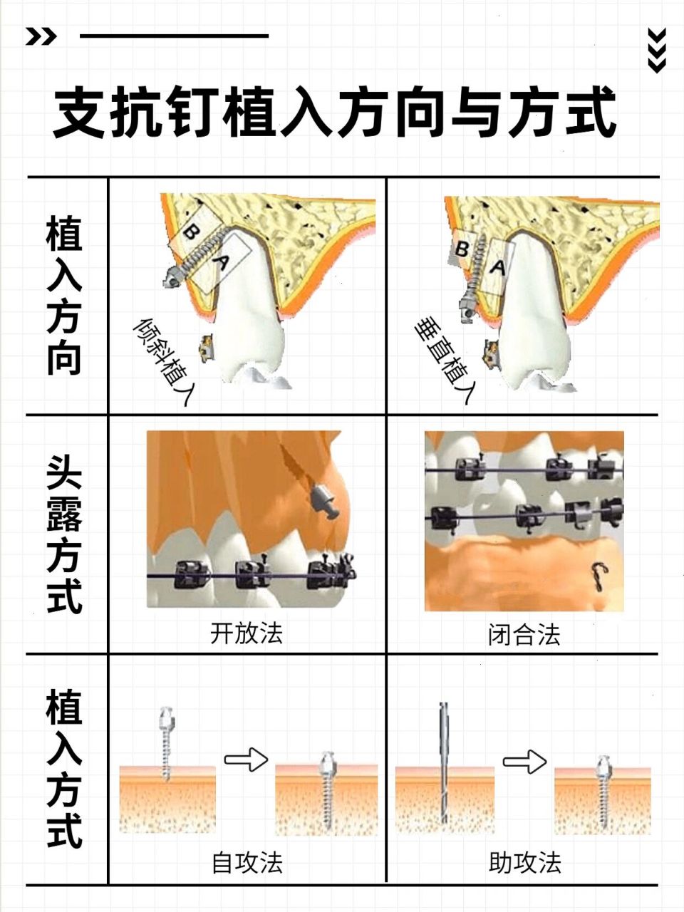 支抗钉植入方向与方式 植入方向 97倾斜植入 与骨面呈一定角度植入