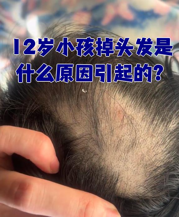 小孩为什么掉头发是什么原因