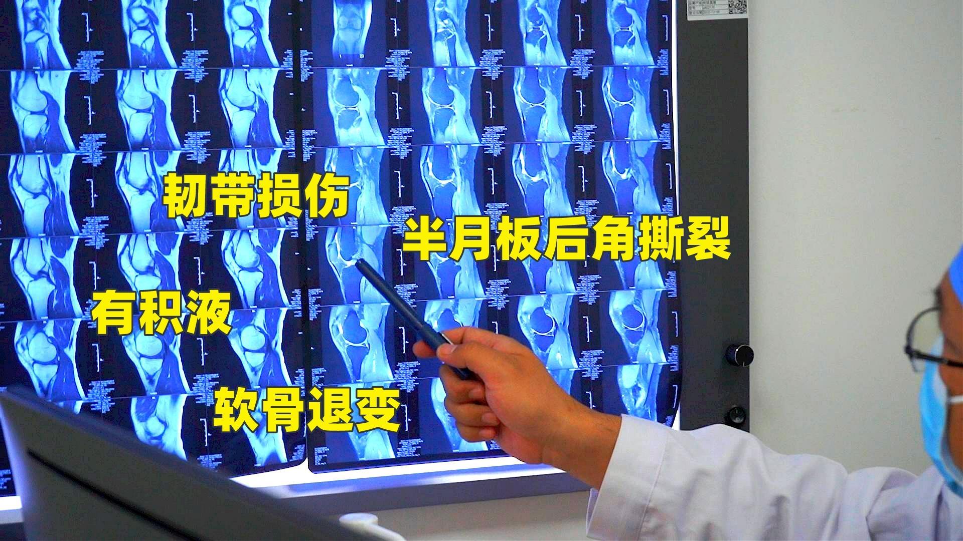 半月板后角变性如何恢复