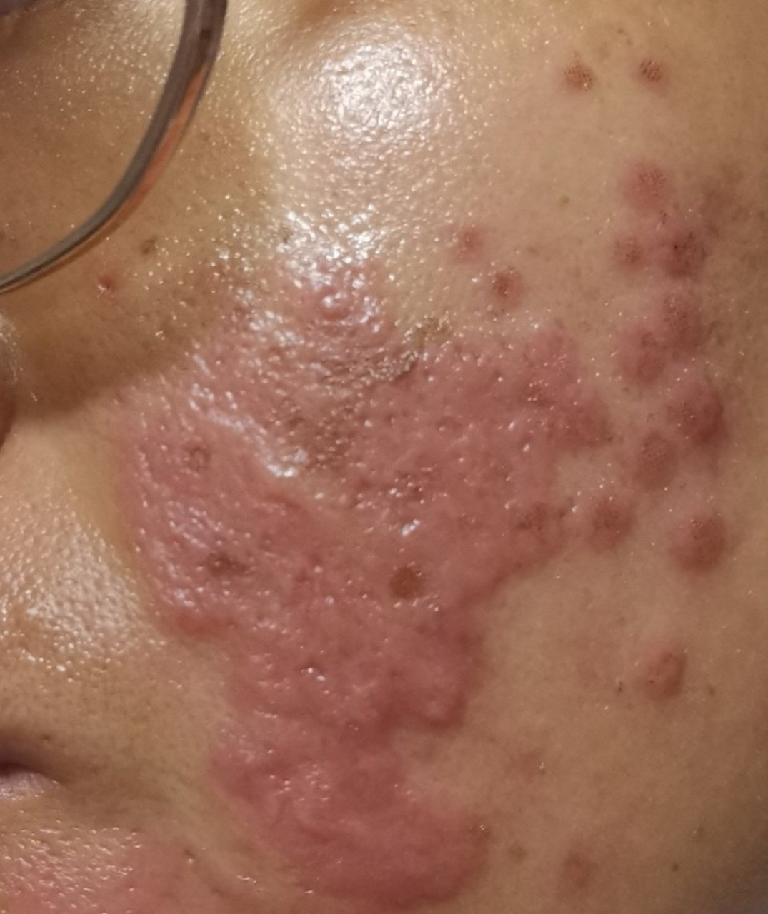 点阵激光治疗痤疮疤痕痘坑痘印后恢复过程图片#激光##解决皮肤问题