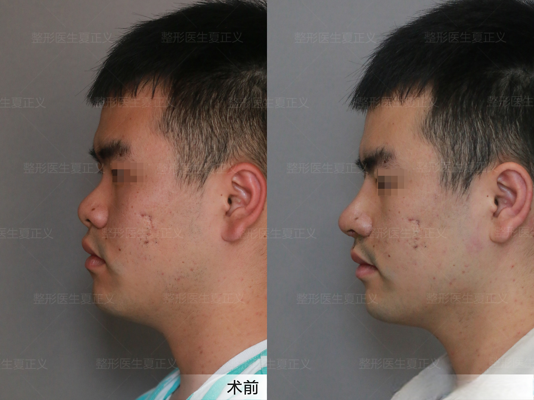 男生短鼻延长术后7天,术前宽鼻,朝天鼻,鼻基底凹陷,肋软骨延长鼻尖