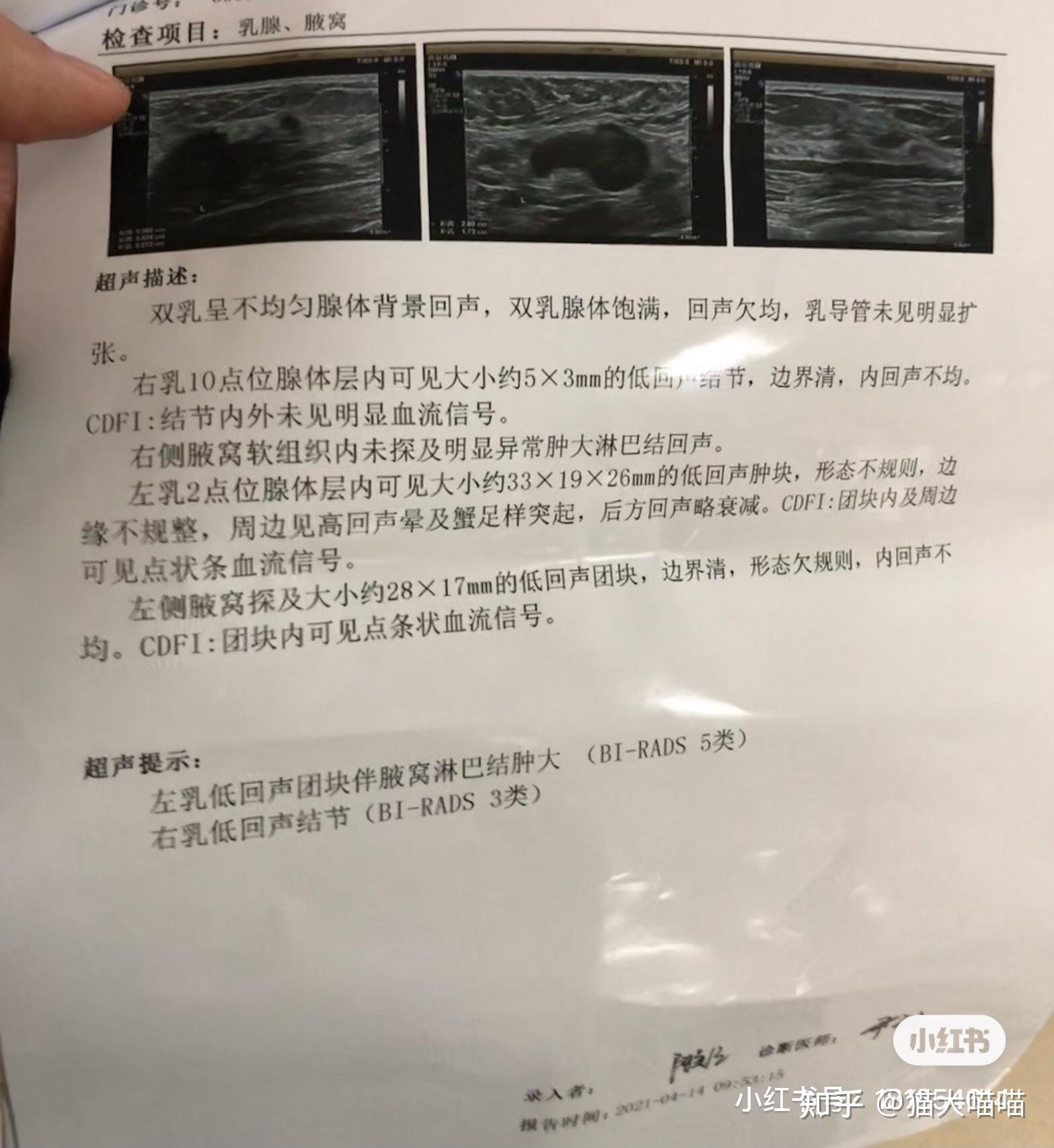 浸润性导管乳腺癌三阴