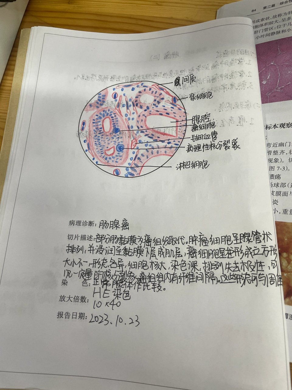 病理学|肠腺癌红蓝铅笔绘图 肠腺癌红蓝铅笔绘图