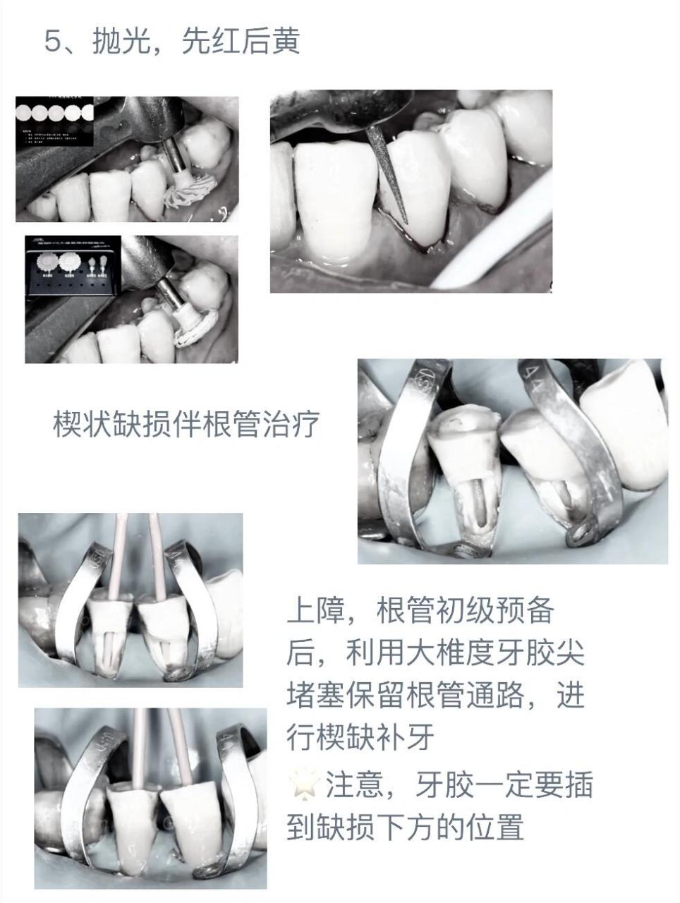 楔状缺损补牙/敏感 祝大家新年快乐🎉,在家快快乐乐的休息吧