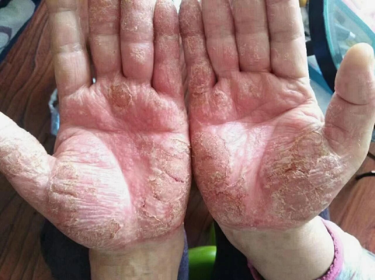 鹅掌风也叫手癣,主要有红毛癣菌感染引起,接触化学物和洗涤剂,脚气