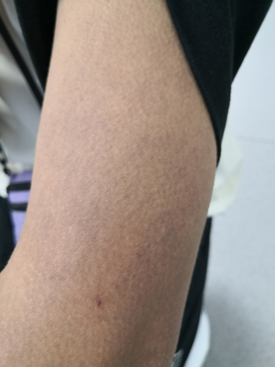 全身泛发色素沉着过度症状#黑变病##色素沉着