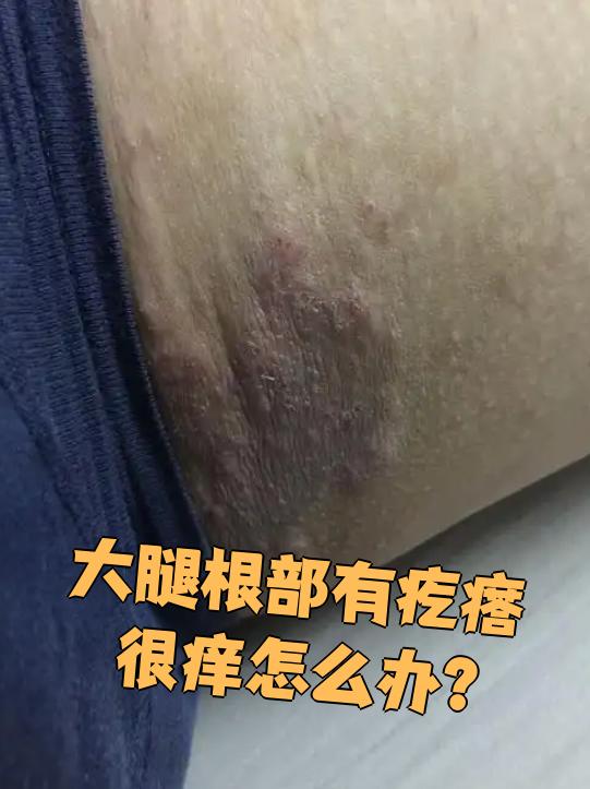大腿根部起疙瘩还特别痒,这种情况可能是股癣或者湿疹,需要先搞清楚