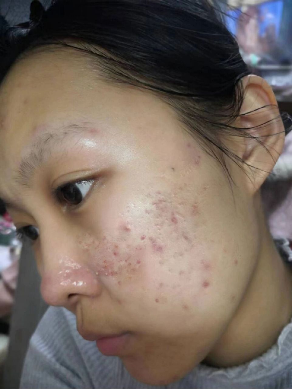 总有姐妹私信问我去痘印的事,姐妹们听我的劝痘痘脸秒变透净光脸!