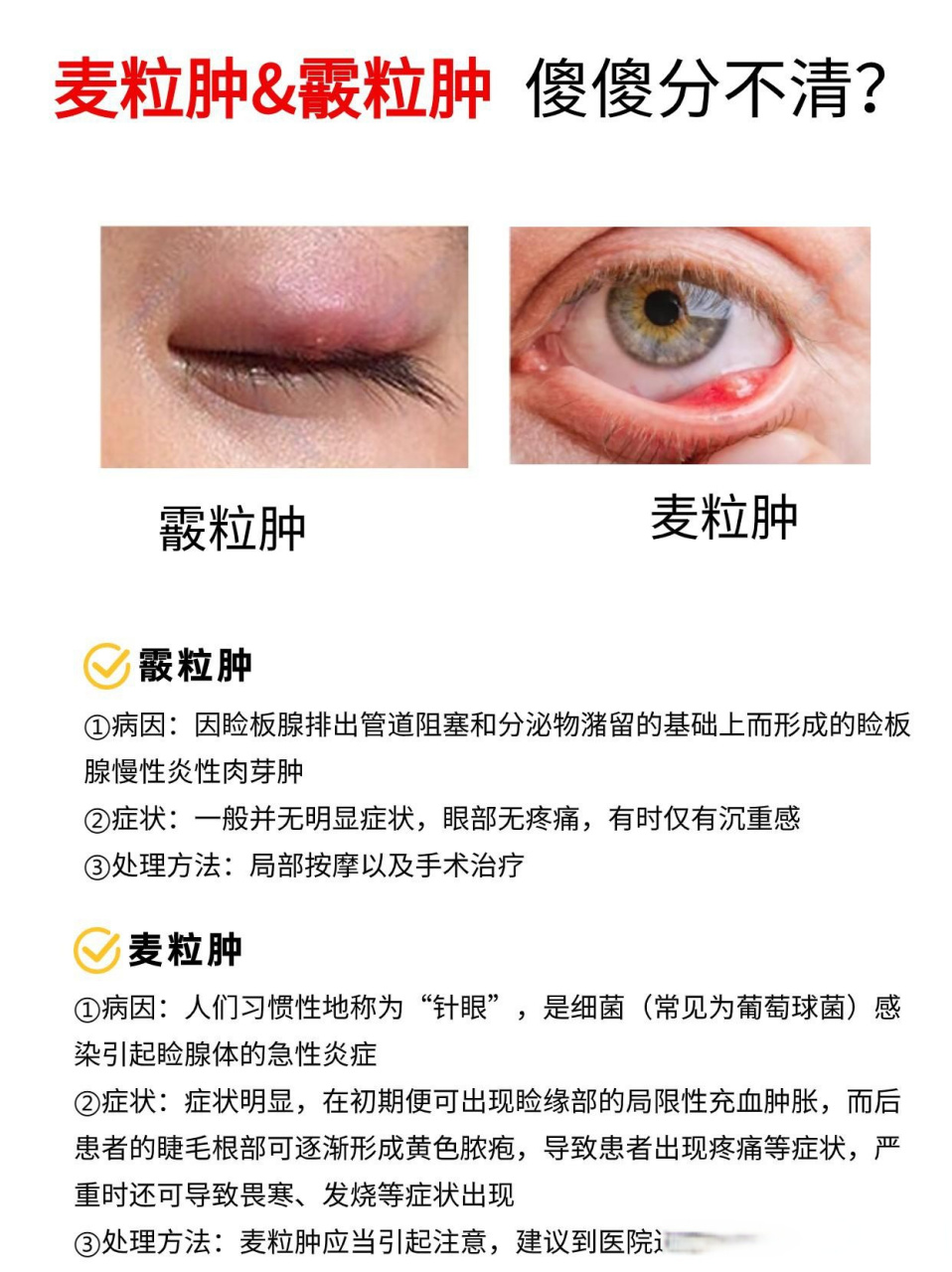 麦粒肿&霰粒肿  傻傻分不清?