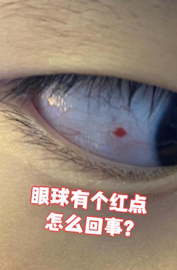 第二种是结膜微血管瘤