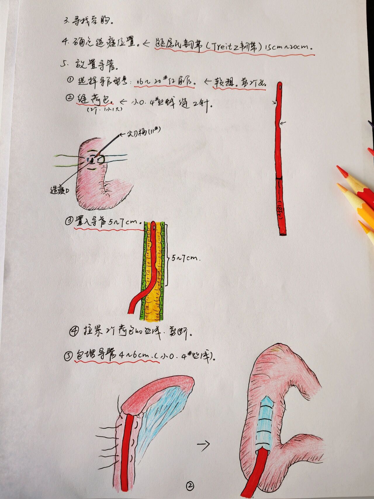 今日手术:空肠造瘘术.