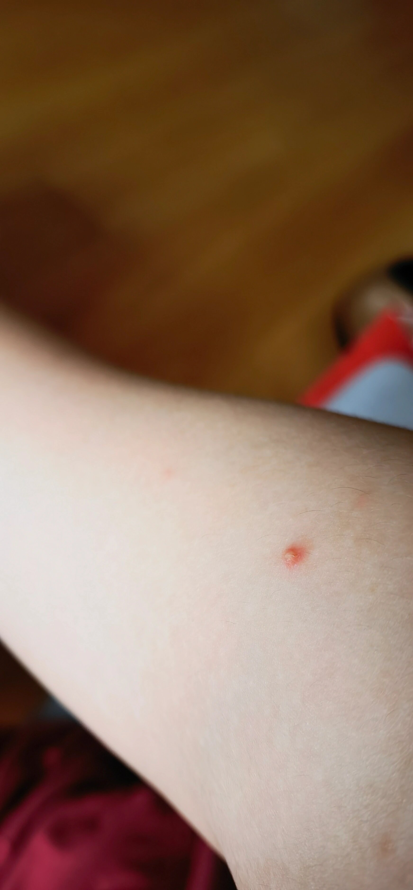 孕妇长红疙瘩 应该是7周左右开始的 现在10周多还有 原来是不打算管的