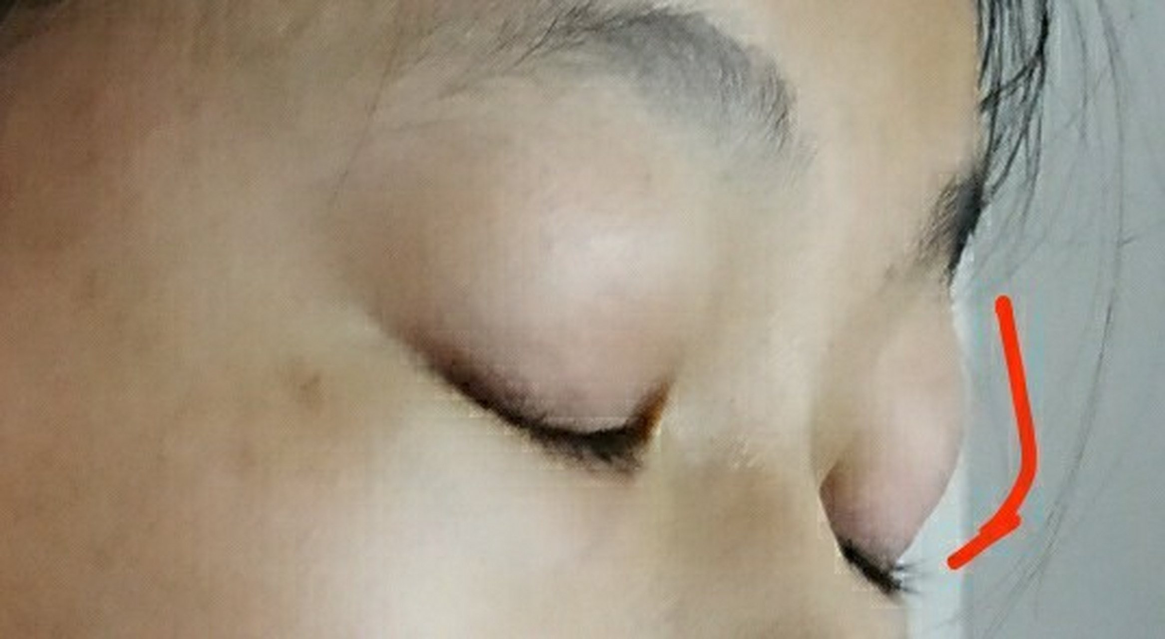 眼球越来越凸到底为什么?