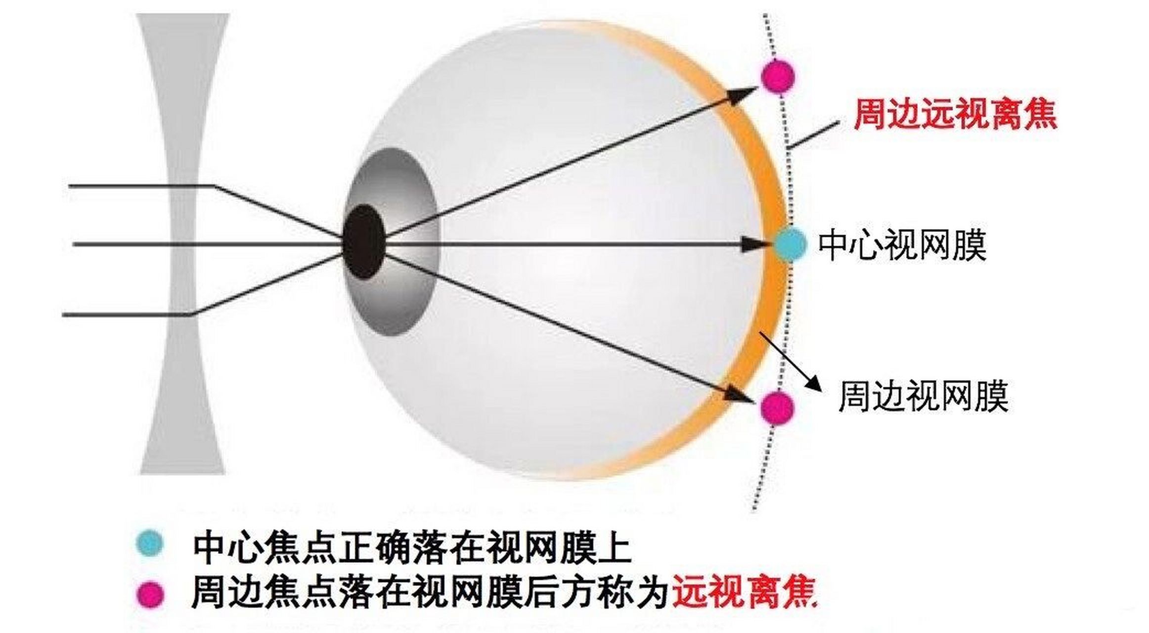 近视眼形成的原理图片