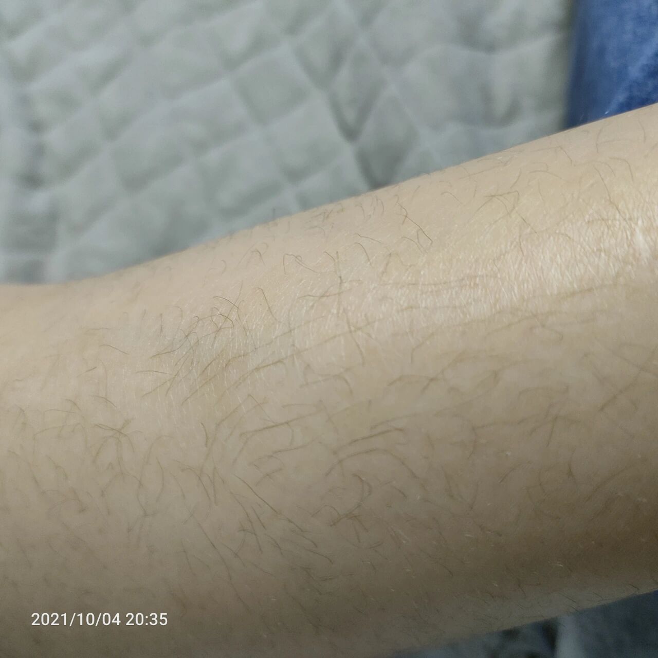 五岁女孩腿上长的汗毛,正常吗?