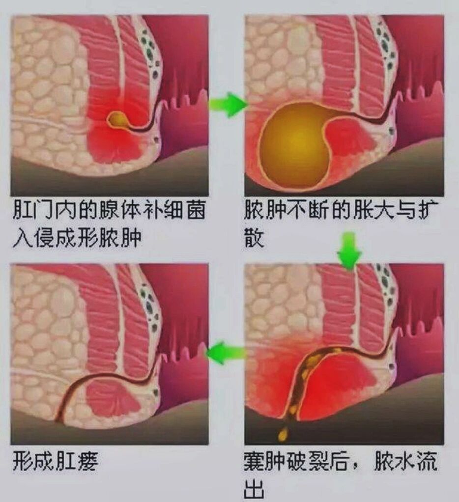 肛周脓肿女生肛瘘图图片