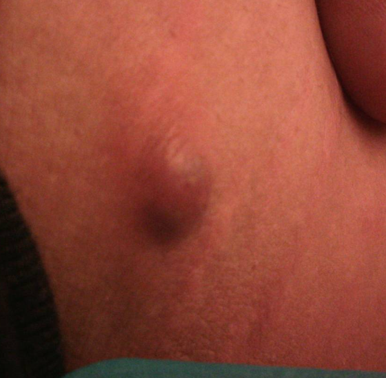 大腿内侧长红色疙瘩怎么回事?