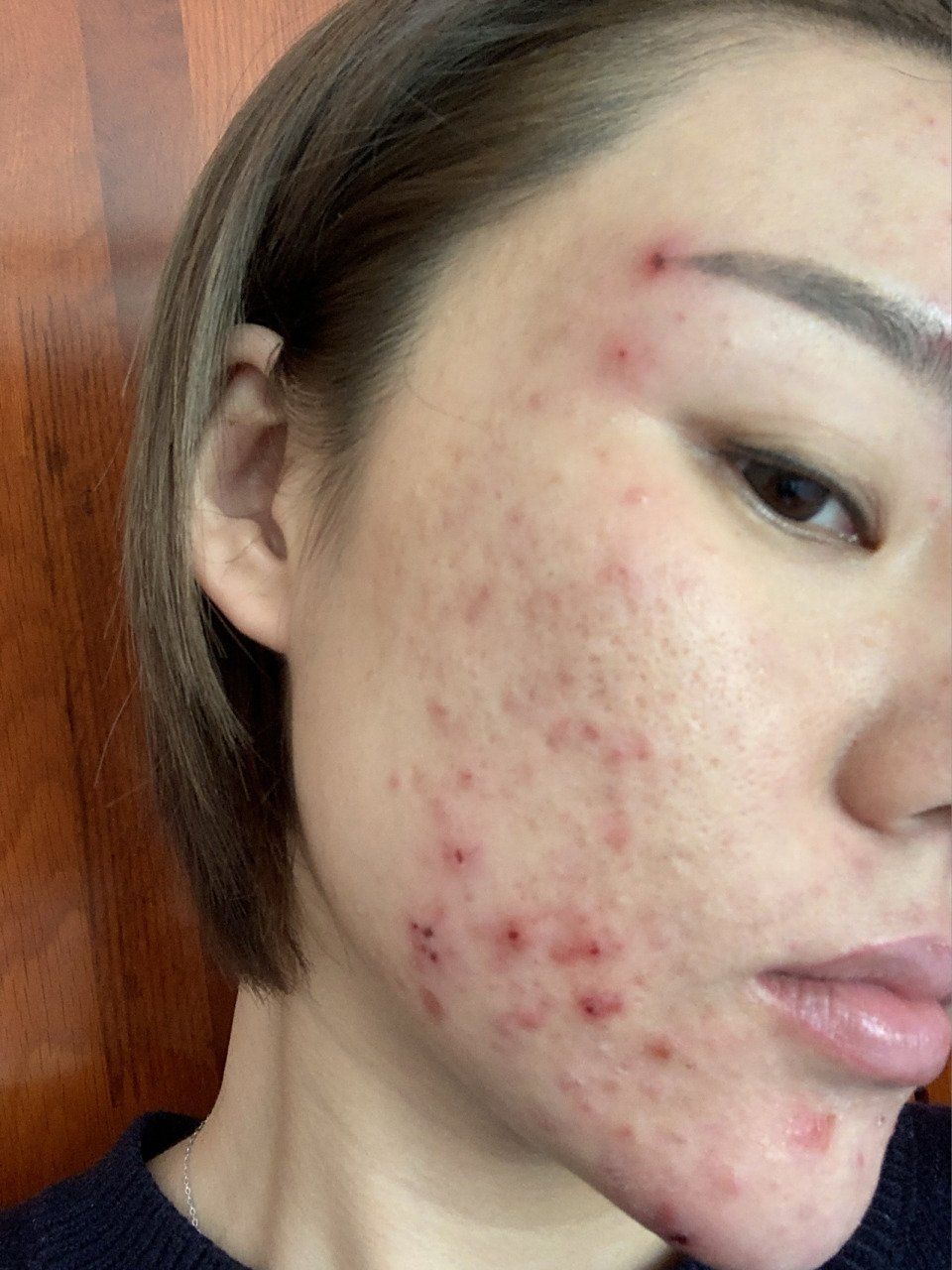 异维a酸软胶囊第14天(第一次针清) 今天去针清