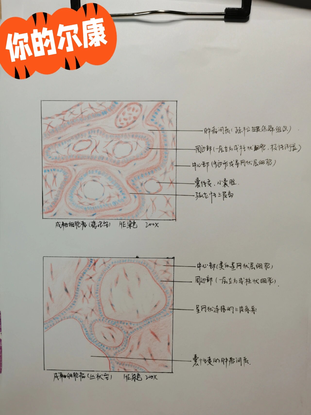 成釉细胞瘤丛状型图片