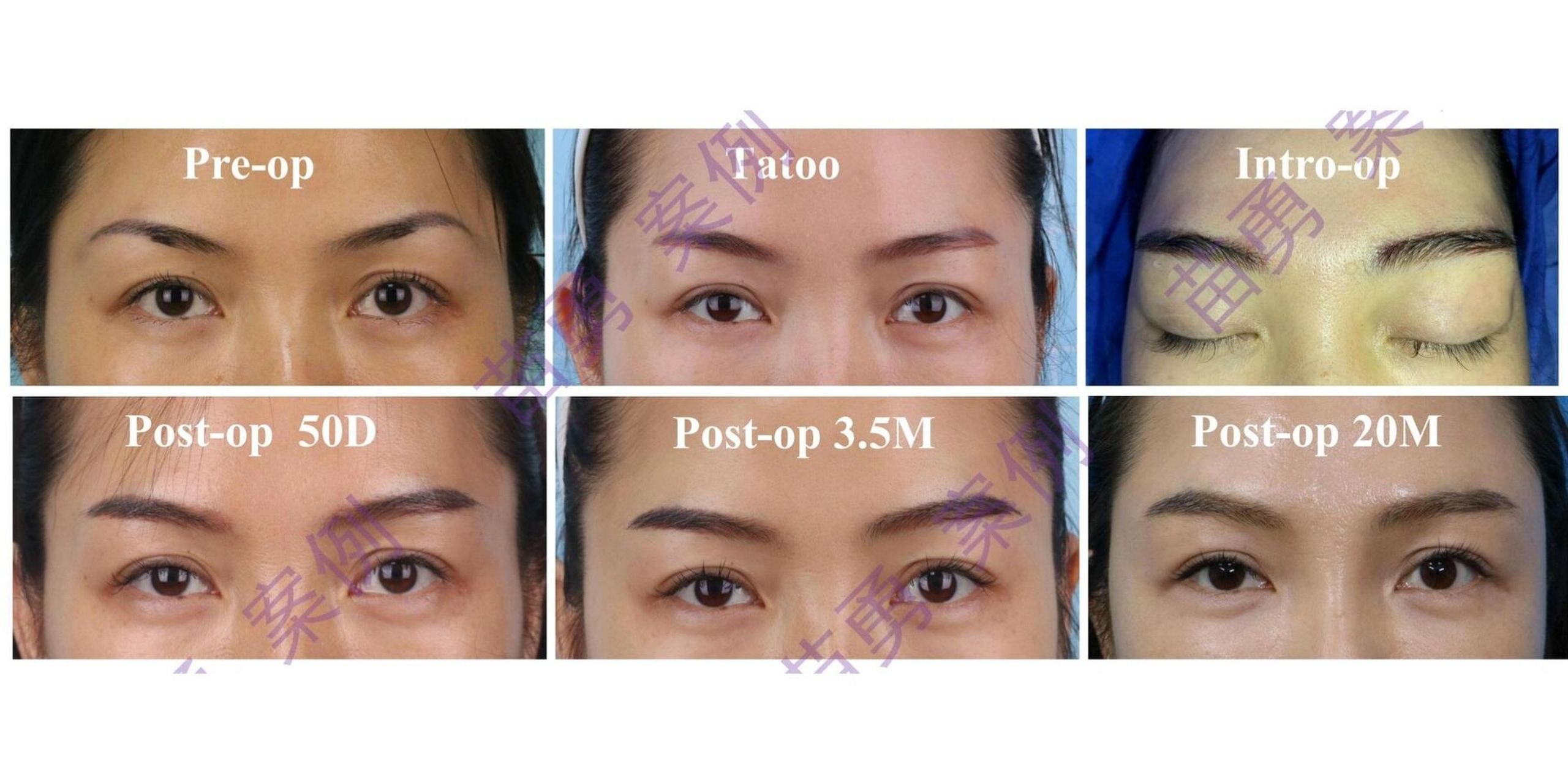 女性眉毛种植(4) #眉毛# #种植眉毛# #眉毛种植毛发移植技术# #纹眉