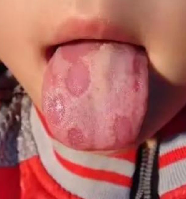 孩子舌头溃烂可能和多种原因有关,比如缺乏维生素,机械损伤,口腔溃疡