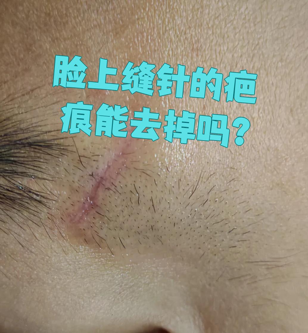 脸上缝针留下的疤痕是可以改善或去除的,主要看疤痕的严重程度