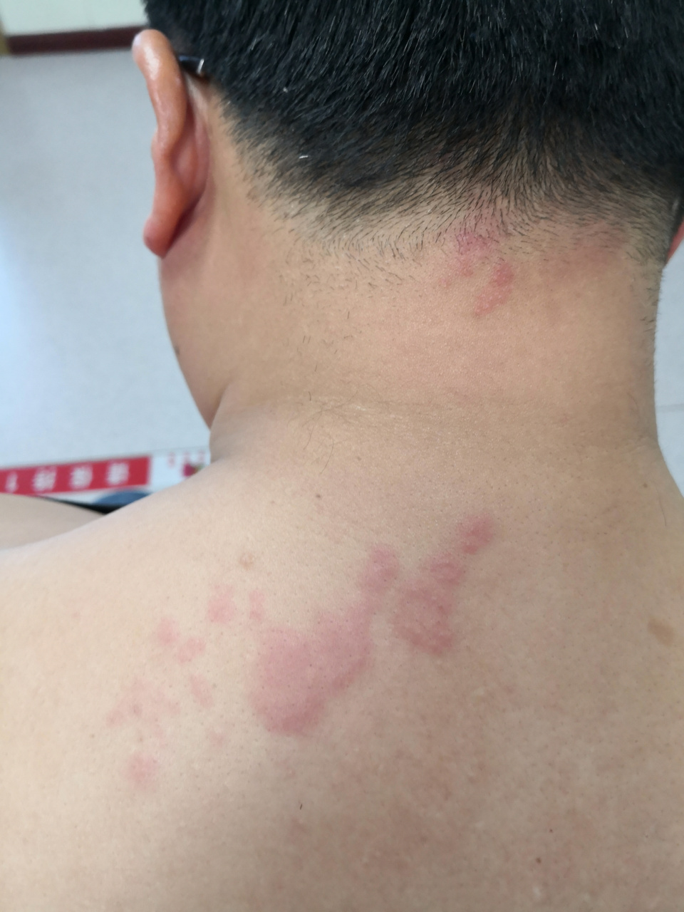 头颈部和一侧肩部的红斑水疱症状,疼痛轻微.考虑带状疱疹早期症状.#带