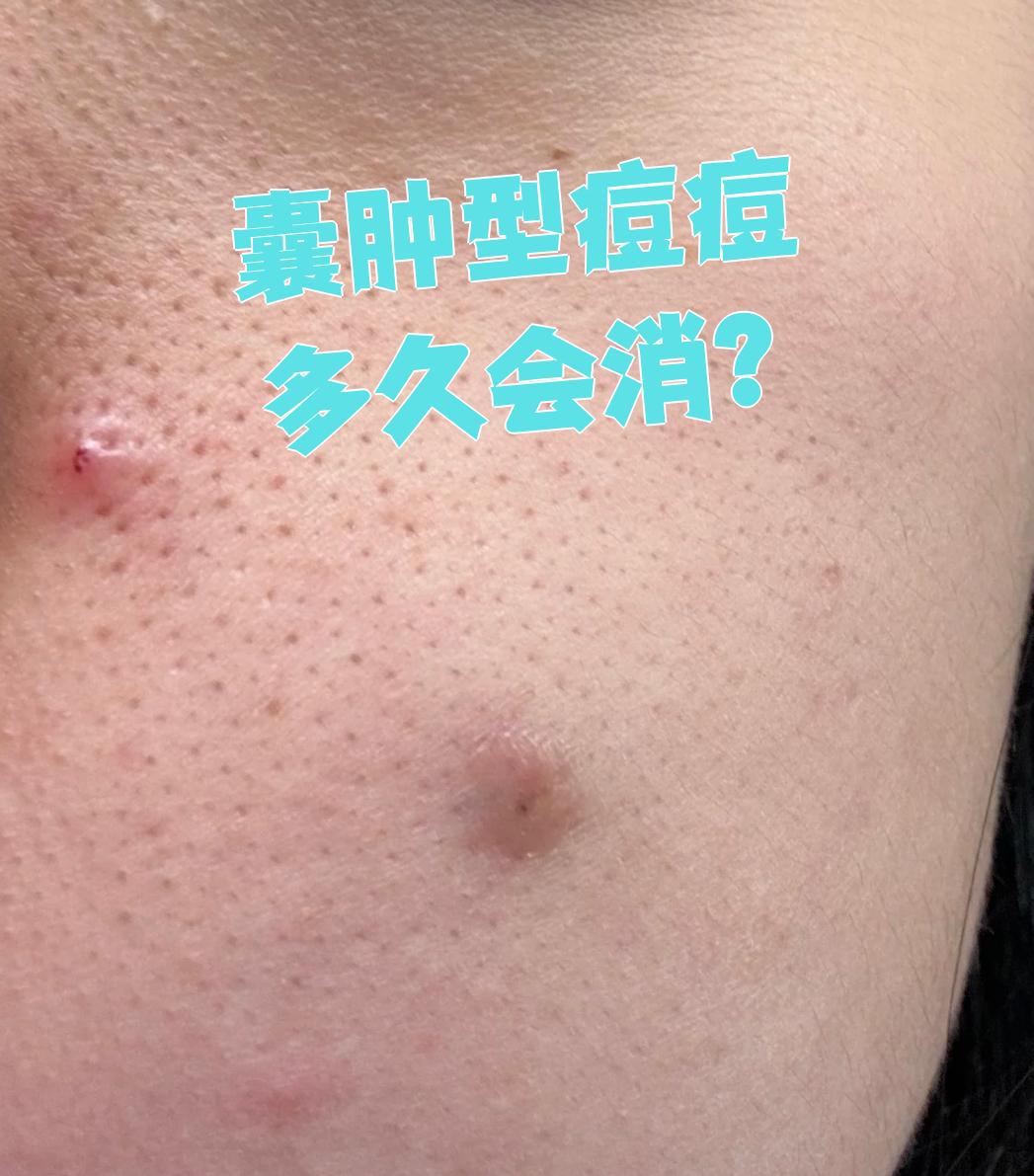 囊肿型痘痘多久能好要看严重程度